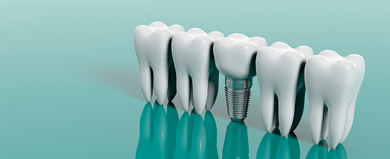 Implante dentário: curiosidades sobre o procedimento no blog da DentCare 