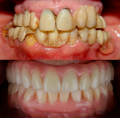 antes e depois protocolo superior e inferior - rizi dental 
