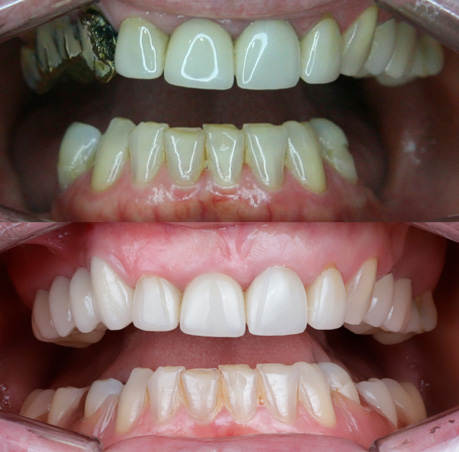 antes e depois prótese dentária - rizi dental 